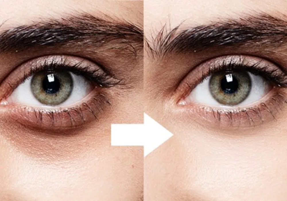 Removing dimples and dark circles under the eyes with filler injections